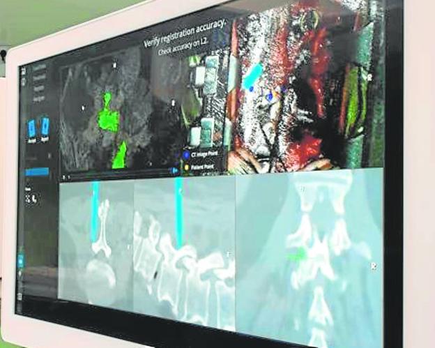 La imagen que ofrece el neuronavegador durante la operación. 