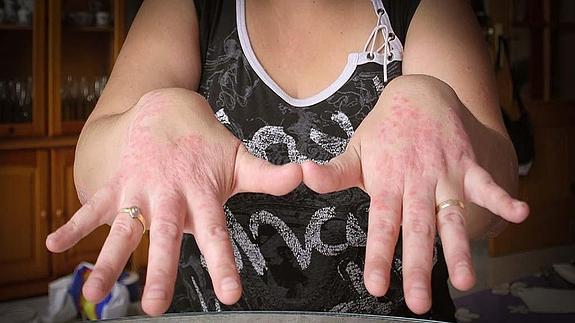 Imagenes de psoriasis en las manos